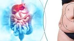 Low Cost Obesity Surgery in Goa